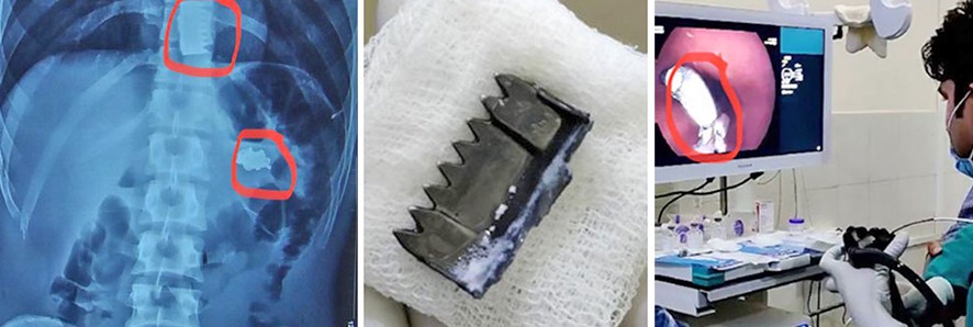 २१ वर्षीय युवकले आवेगमा मर्छु भन्दै सिक्री र बकल निलेपछि….?